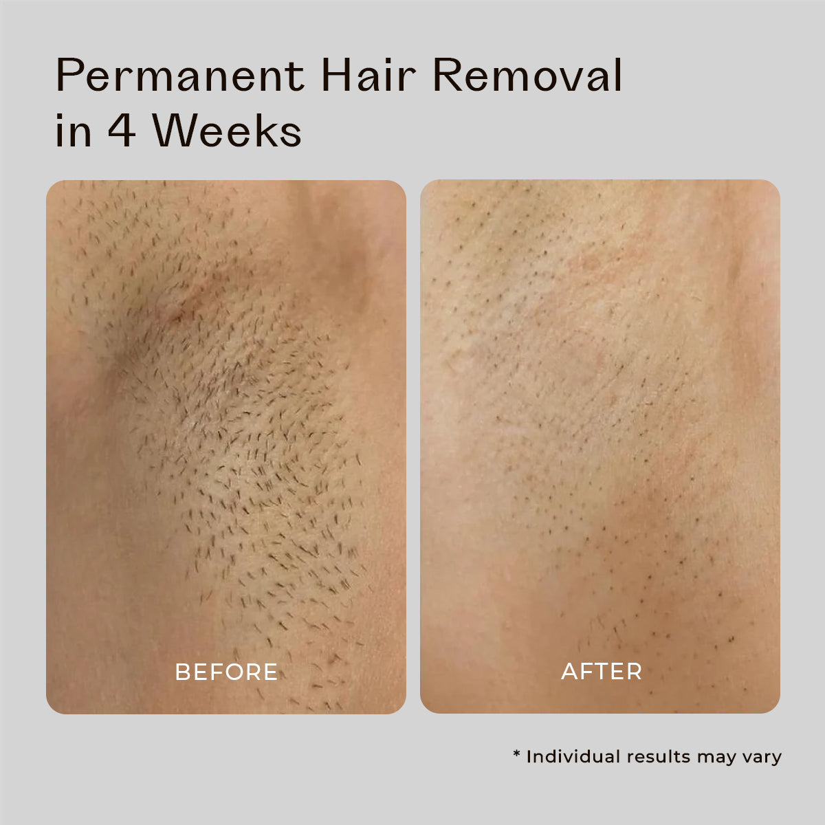 5MINSKIN AT-HOME LASER-HAARENTFERNUNGSGERÄT