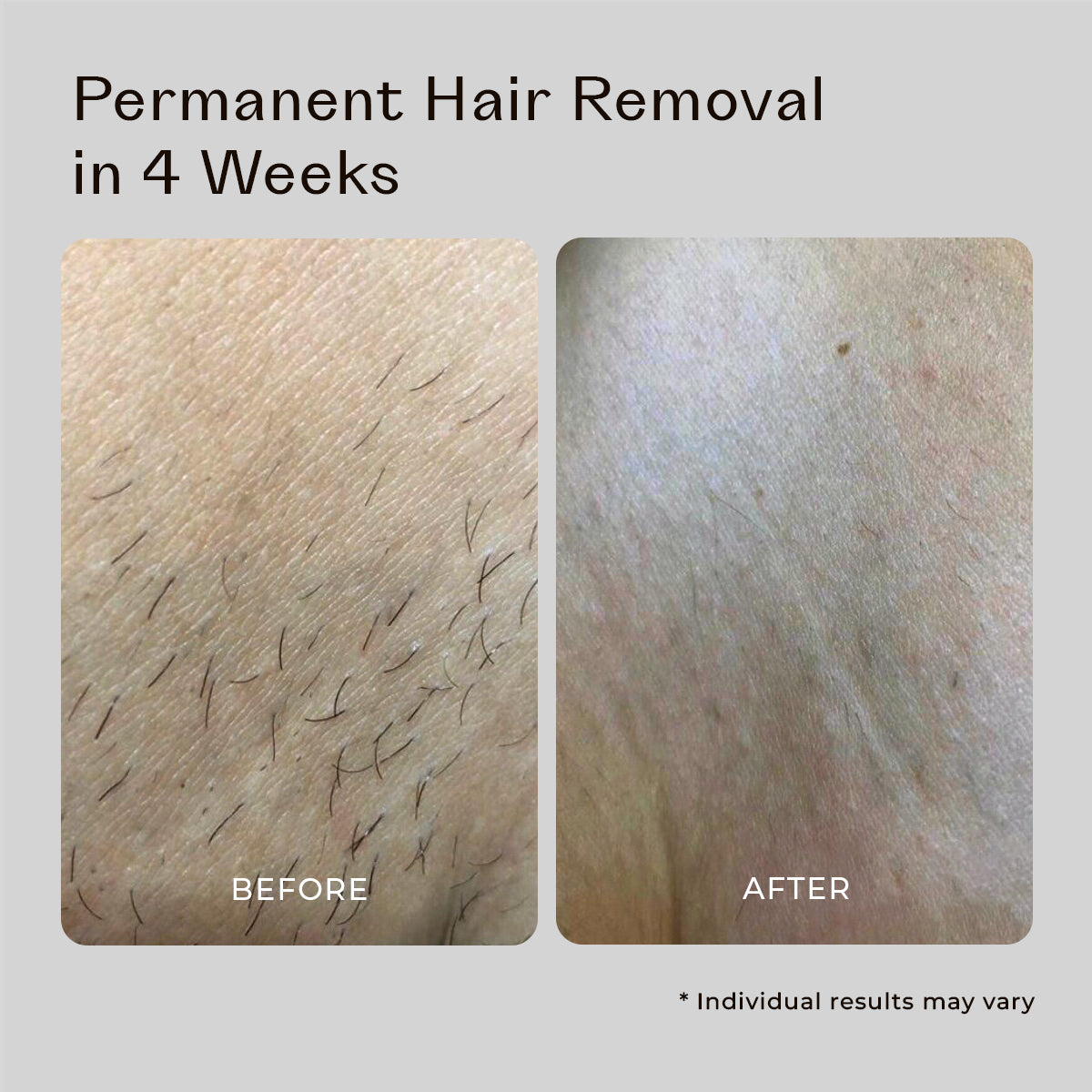 5MINSKIN AT-HOME LASER-HAARENTFERNUNGSGERÄT
