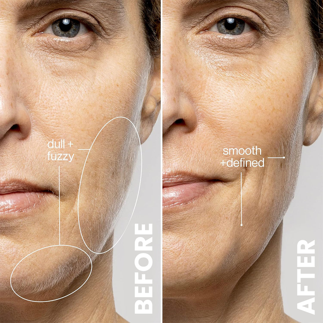 5MINSKIN AT-HOME LASER-HAARENTFERNUNGSGERÄT