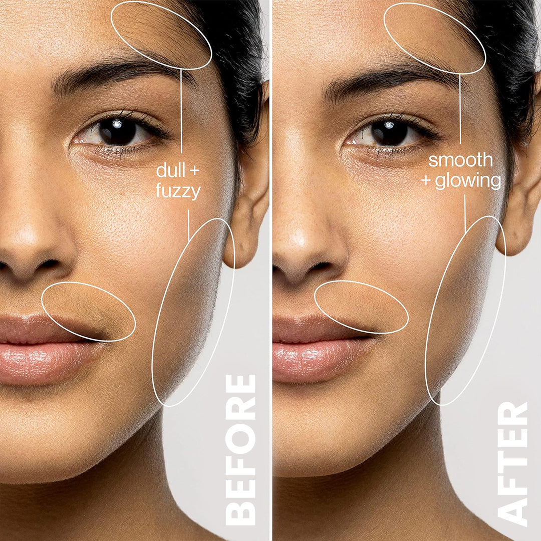 Acne- en Leeftijdsvlekken Verwijderingsaccessoires ($29/ELK)