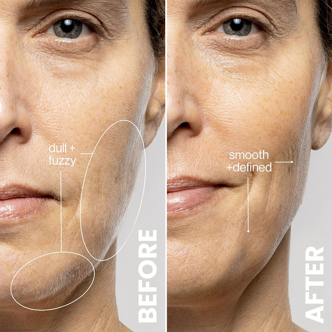 Acne- en Leeftijdsvlekken Verwijderingsaccessoires ($29/ELK)